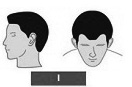 Ilustración de la alopecia de clase 1 con pelo normal