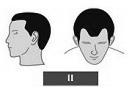 Ilustración de la alopecia de clase 2 Un poquito de entradas y un poquito de coronilla