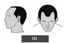 Ilustración de la alopecia de clase 3, entradas mas pronunciadas
