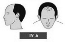 Ilustración de la alopecia de clase 4A media frente
