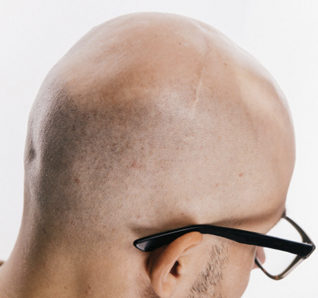 Foto de un hombre con cicatriz en la cabeza de una mala operación de injerto capilar