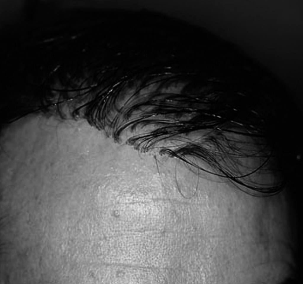 Foto de un hombre que lleva injertado pelo de muñeca